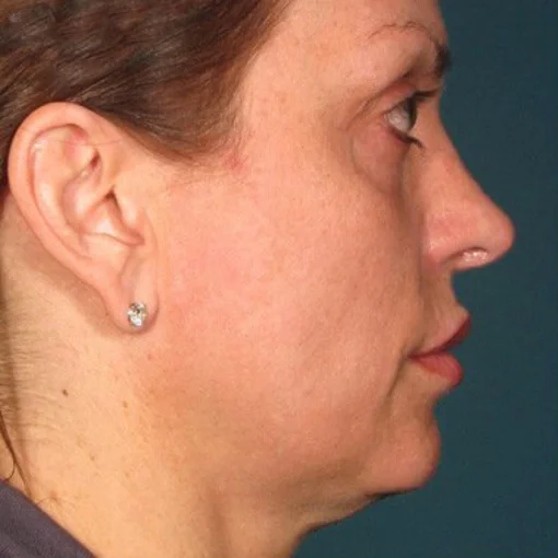 signature cosmetic clinic ultherapy before 1