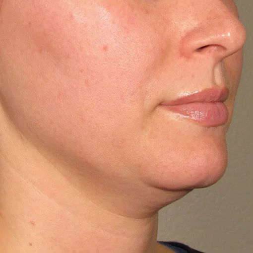 signature cosmetic clinic ultherapy before 3