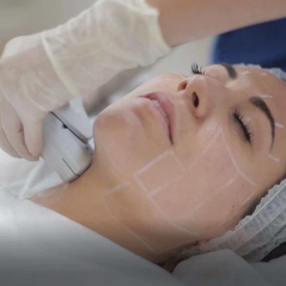 ultherapy treatment signature cosmetic clinic