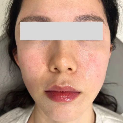 Restylane Skin Booster Signature Cosmetic Clinic Before After 3