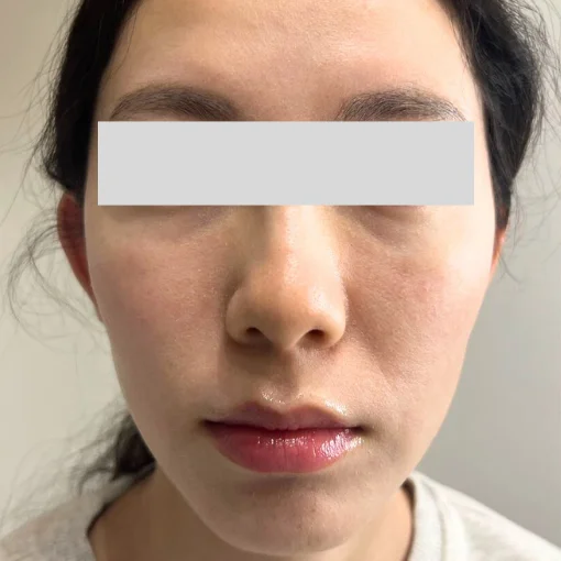 Restylane Skin Booster Signature Cosmetic Clinic Before After 4
