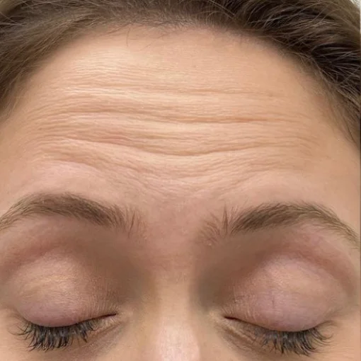signature cosmetic clinic botox before after 1
