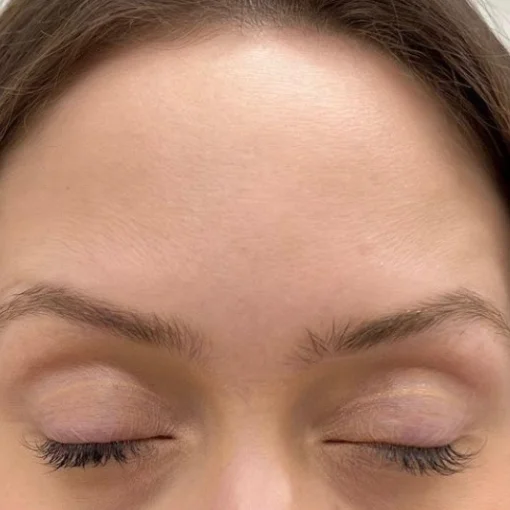 signature cosmetic clinic botox before after 1