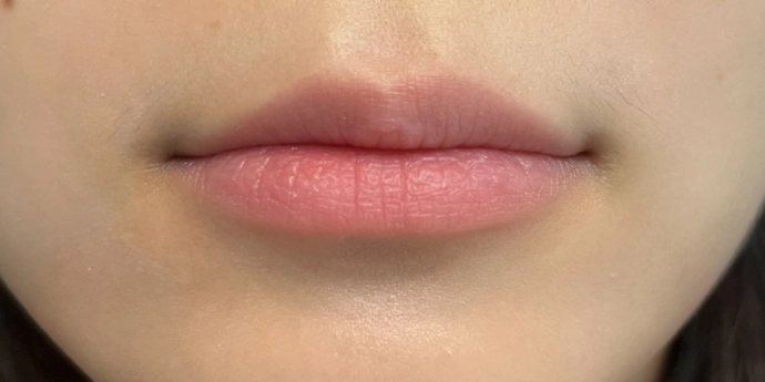signature cosmetic clinic lip filler before after 1