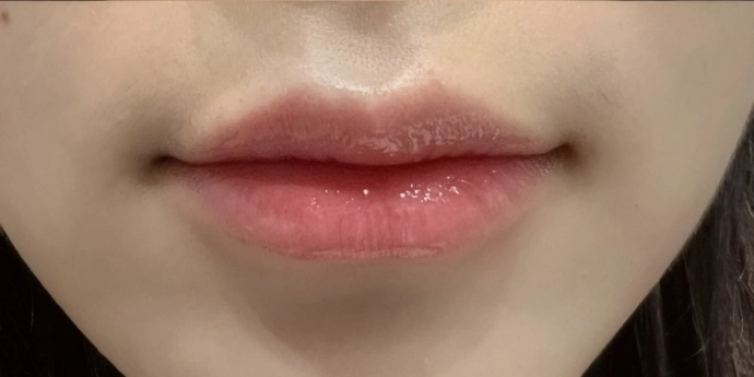 signature cosmetic clinic lip filler before after 2