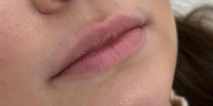 signature cosmetic clinic lip filler before after 3