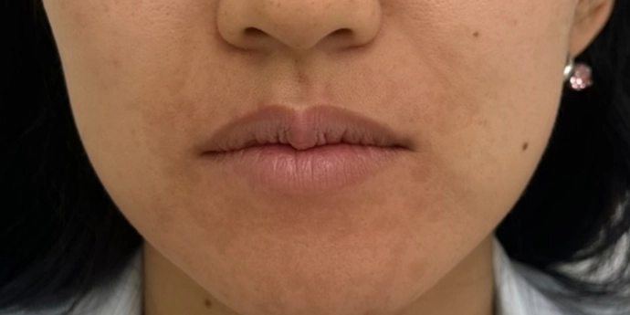 signature cosmetic clinic lip filler before after 7