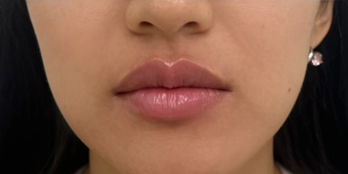 signature cosmetic clinic lip filler before after 8