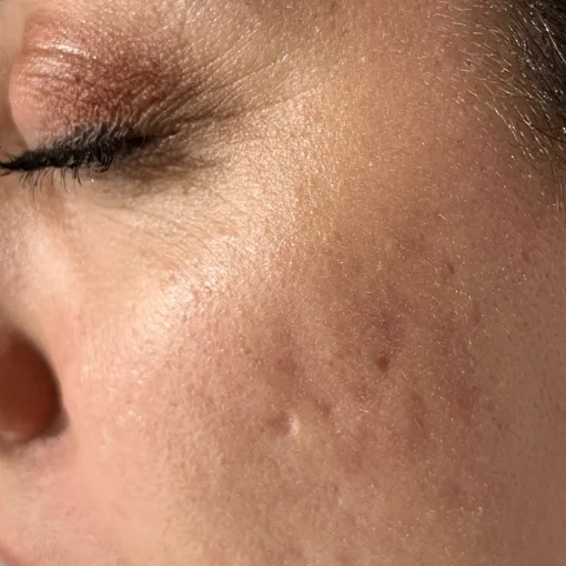 signature korean glass facial before after 1
