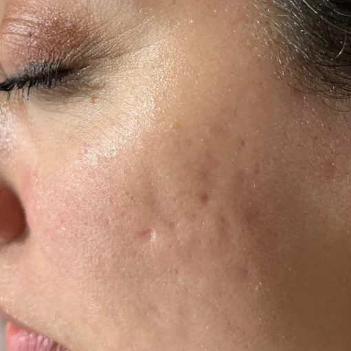 signature korean glass facial before after 2