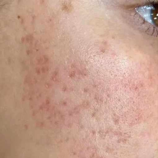Exosomes Therapy Before After 1
