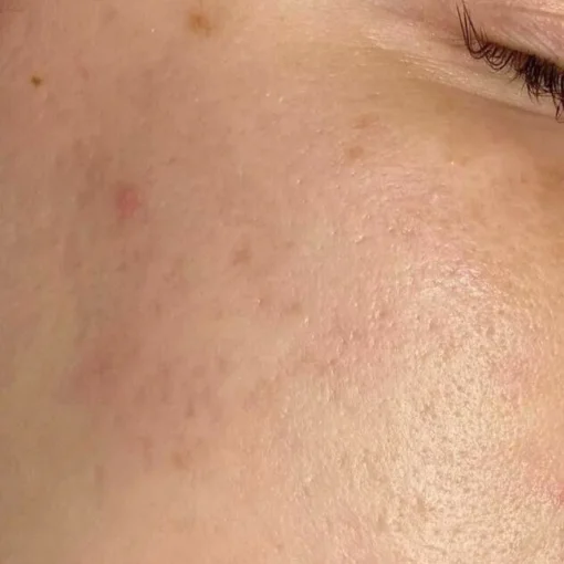 Exosomes Therapy Before After 2