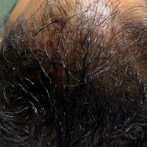 Exosomes Therapy Before After 6
