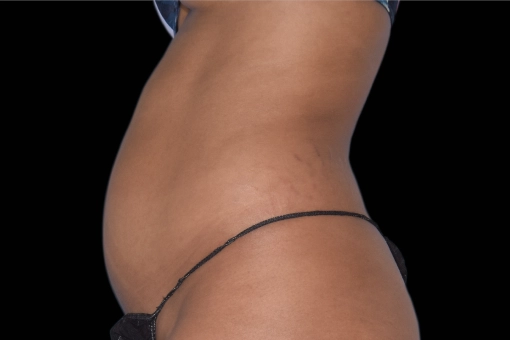 Signature Cosmetic Clinic Emsculpt NEO Before and After 1
