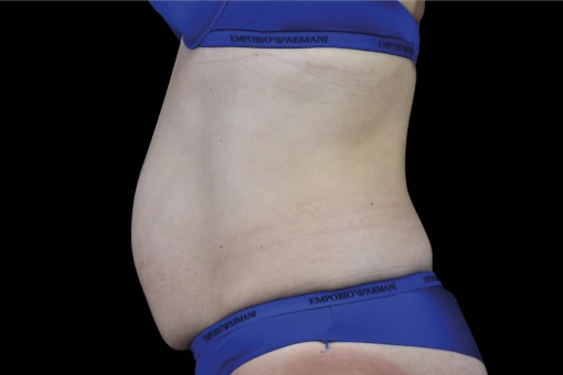 Signature Cosmetic Clinic Emsculpt NEO Before and After 10