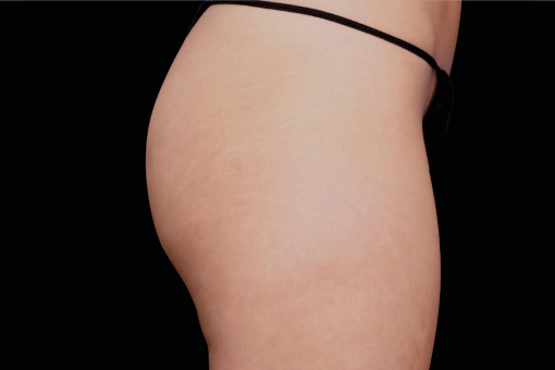 Signature Cosmetic Clinic Emsculpt NEO Before and After 3