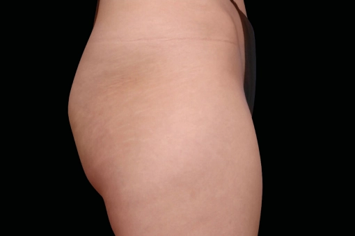 Signature Cosmetic Clinic Emsculpt NEO Before and After 4