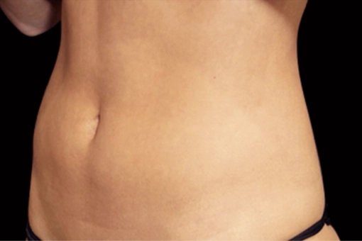 Signature Cosmetic Clinic Emsculpt NEO Before and After 5