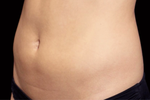 Signature Cosmetic Clinic Emsculpt NEO Before and After 6