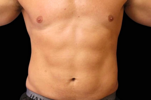 Signature Cosmetic Clinic Emsculpt NEO Before and After 7
