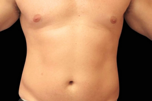 Signature Cosmetic Clinic Emsculpt NEO Before and After 8