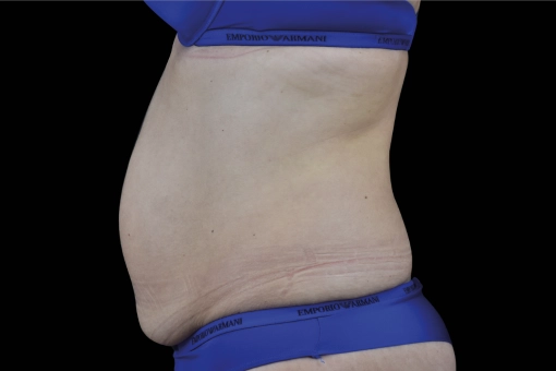 Signature Cosmetic Clinic Emsculpt NEO Before and After 9
