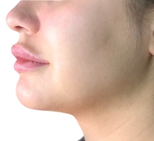 Signature Cosmetic Clinic SculpSure Before After 1