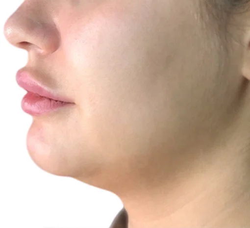Signature Cosmetic Clinic SculpSure Before After 2