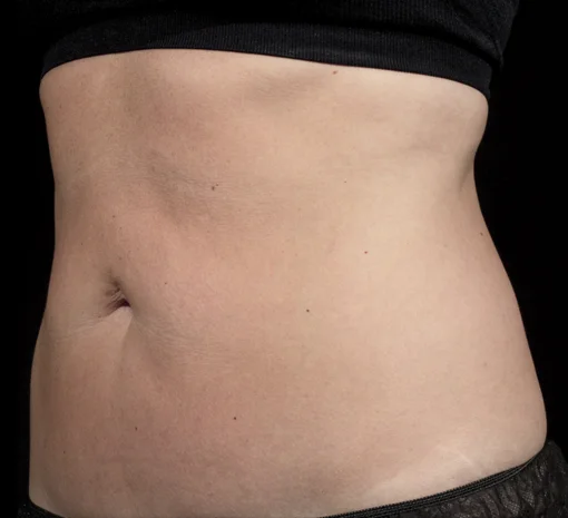 Signature Cosmetic Clinic SculpSure Before After 3