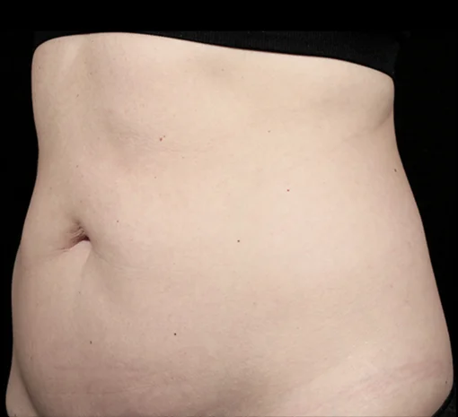 Signature Cosmetic Clinic SculpSure Before After 4