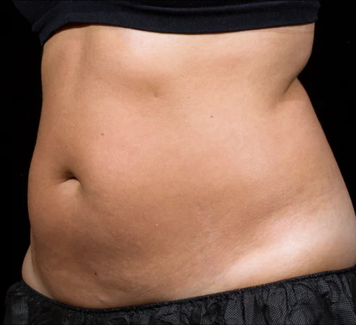 Signature Cosmetic Clinic SculpSure Before After 5
