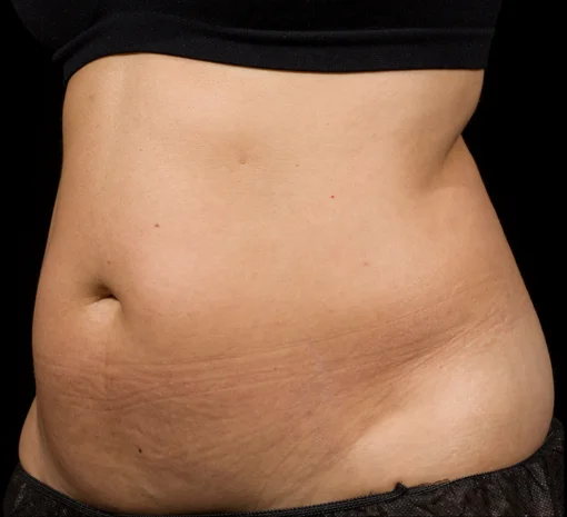 Signature Cosmetic Clinic SculpSure Before After 6