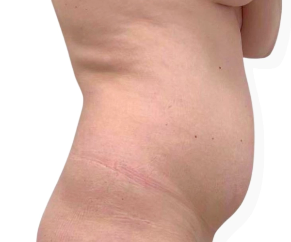 Weight Loss Program before after 1