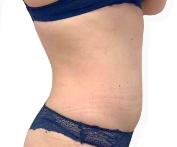 Weight Loss Program before after 2