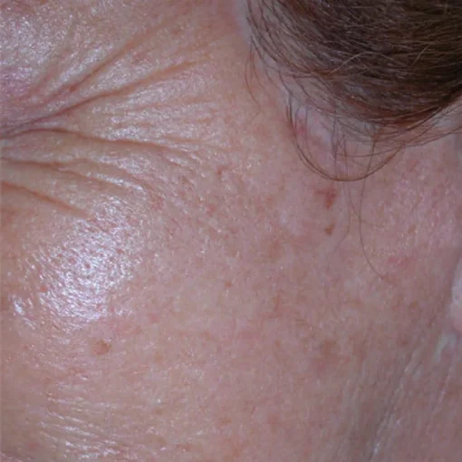 Aqua Peel Before and After 1