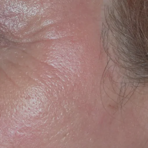 Aqua Peel Before and After 2