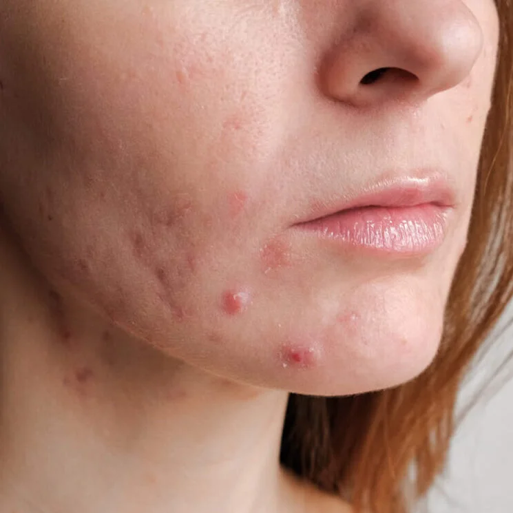 Aqua Peel Before and After 3