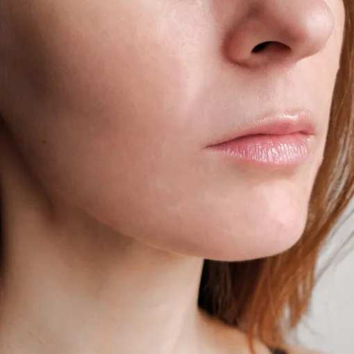 Aqua Peel Before and After 4