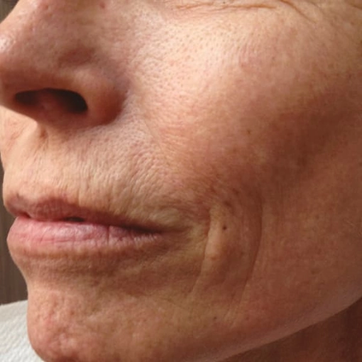 EndyMed Intensif:FSR Before After 1