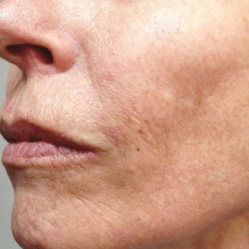 EndyMed Intensif:FSR Before After 2