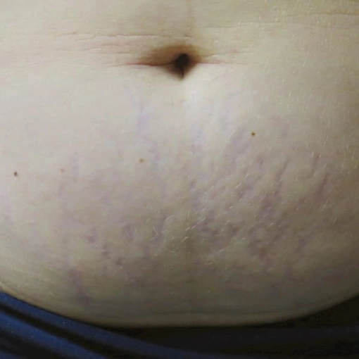 EndyMed Intensif:FSR Before After 3