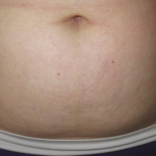 EndyMed Intensif:FSR Before After 4