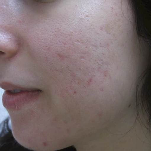EndyMed Intensif:FSR Before After 5