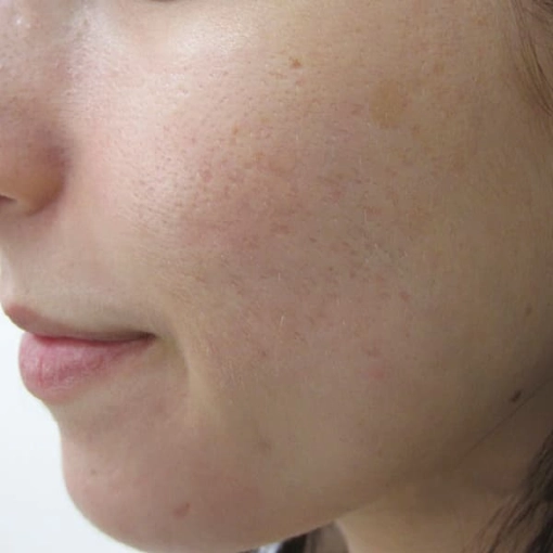 EndyMed Intensif:FSR Before After 6
