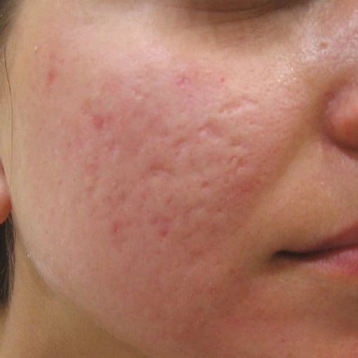 EndyMed Intensif:FSR Before After 7