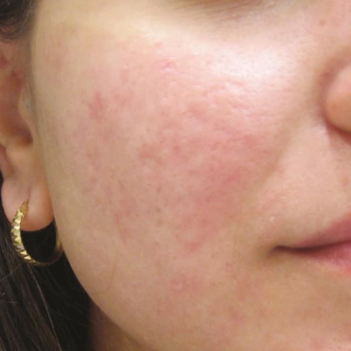 EndyMed Intensif:FSR Before After 8