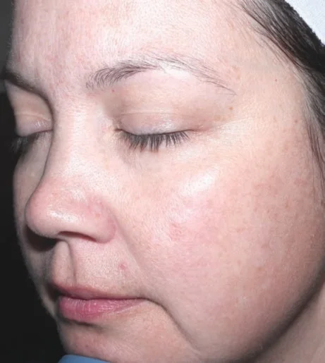 Halo Laser Treatment Before After 1