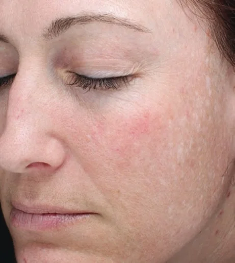 Halo Laser Treatment Before After 10