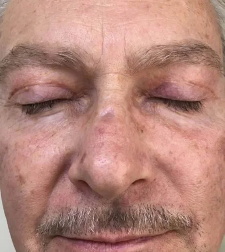 Halo Laser Treatment Before After 11