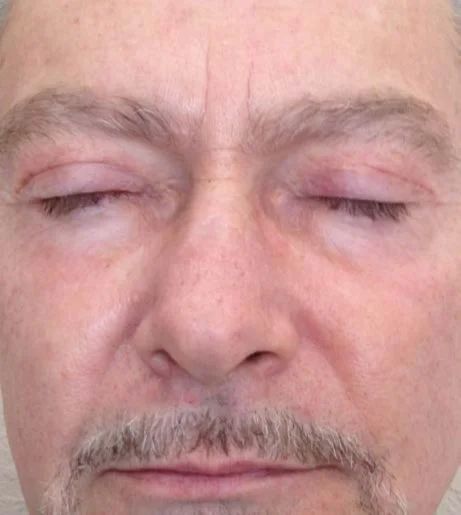 Halo Laser Treatment Before After 12